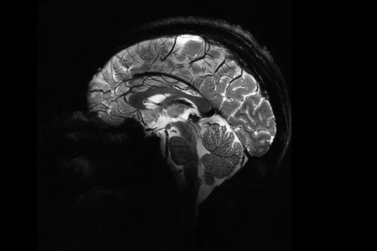 صورة لدماغ الإنسان ملتقطة بجهاز التصوير الحديث وتظهر فيها تفاصيل للمرّة الأولى (هيئة الطاقة الذرية الفرنسية)