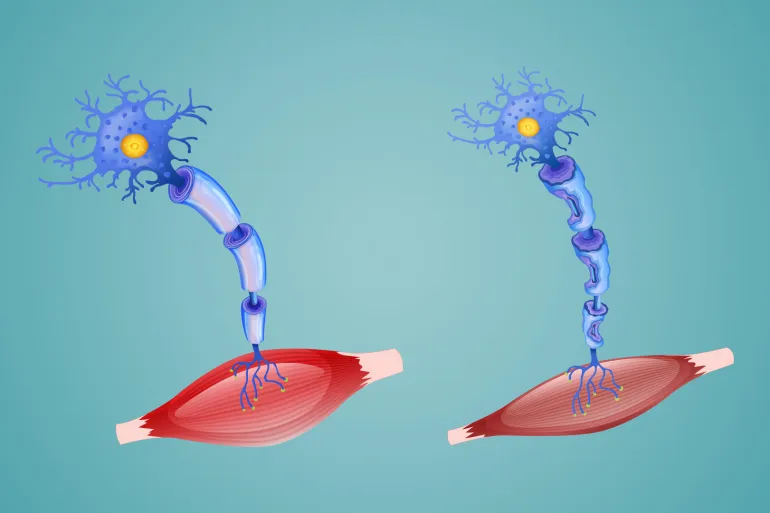 التصلب الجانبي الضموري حالة مرضية تصيب الجهاز العصبي وتؤثر على الخلايا العصبية في الدماغ والحبل الشوكي (الجزيرة)
